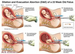 堕胎婴灵是什么