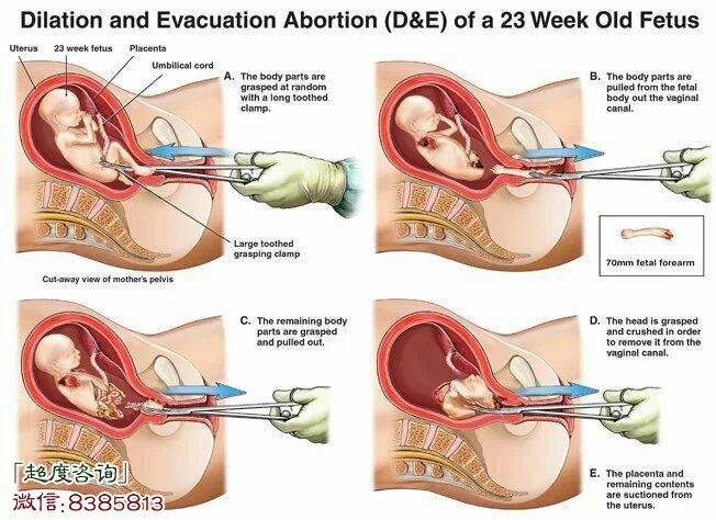 堕胎婴灵是什么